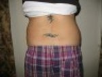 Before smart lipo - back
